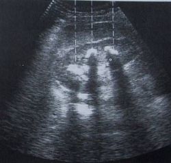 Sonographie: Nierensteine