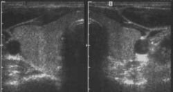 Sonographie: Schilddrüse (Normalbefund)
