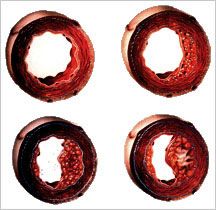 Arteriosklerose Arteriosklerose