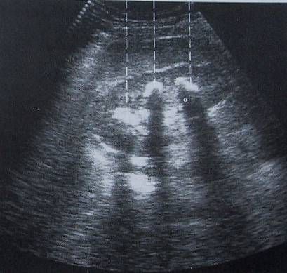 Nierensteine Nierensteine